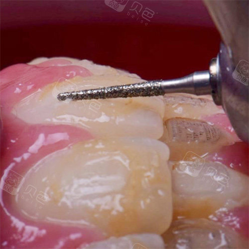 摘牙套过程高清大图分享,粘牙套的胶水原来是这样去掉的!