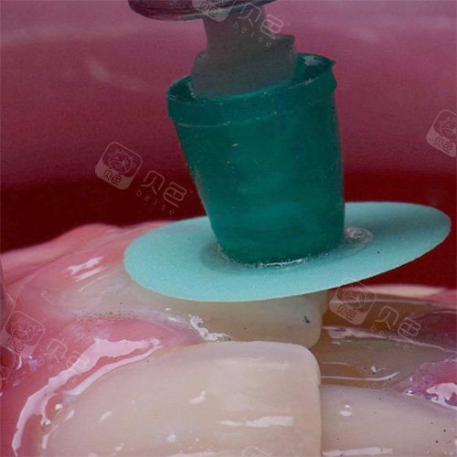 牙齿表面打磨中