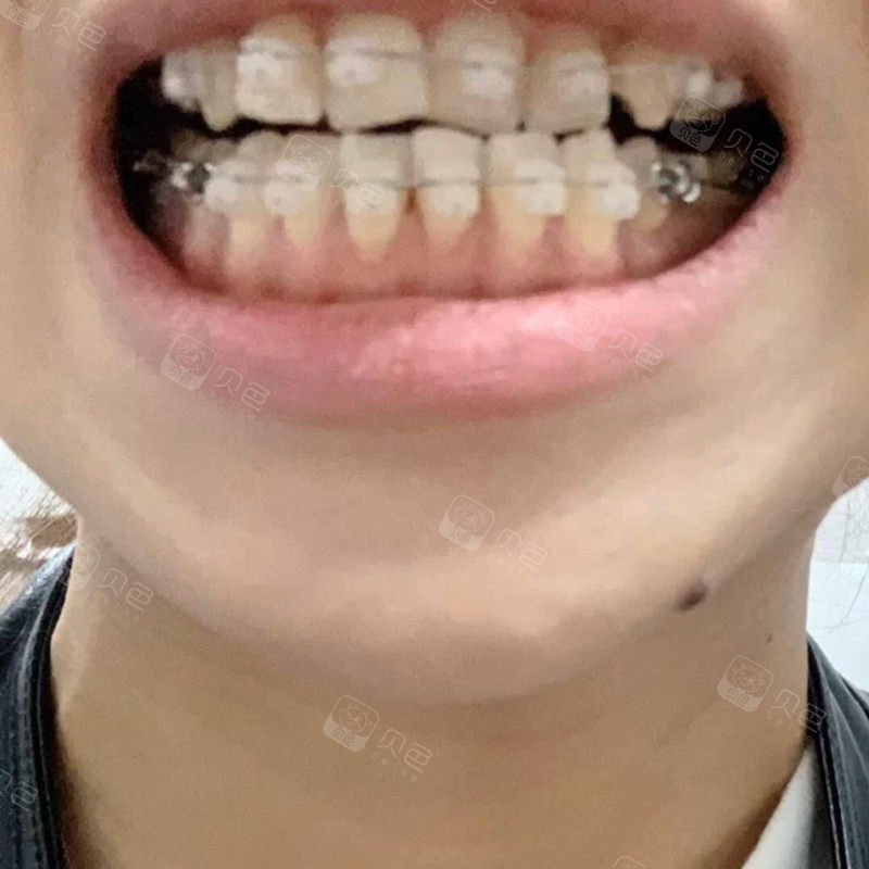 牙齿正畸出现黑三角
