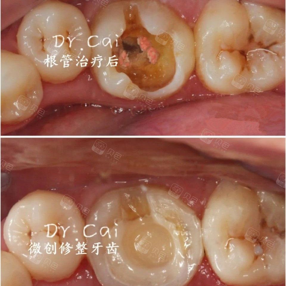 一颗小小的蛀牙想不到这么麻烦,可不能再大意了