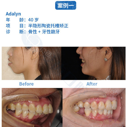 牙齿外突矫正前后对比图