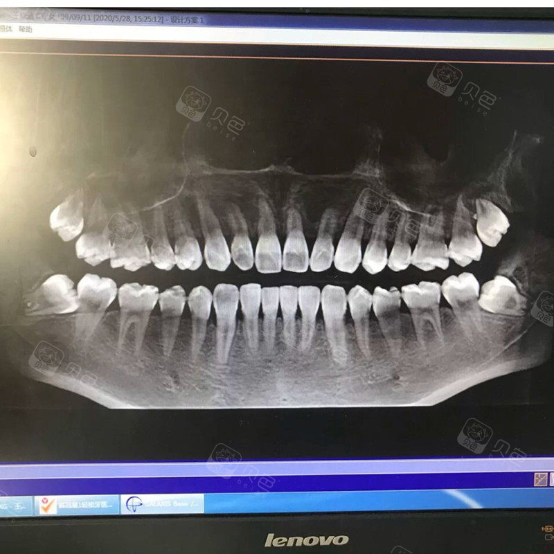 牙齿问题是不是每个人都需要先去拍牙ct? !