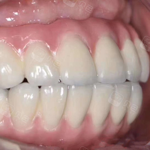 沈阳欢乐口腔全口种植牙案例,术后美食随便吃!