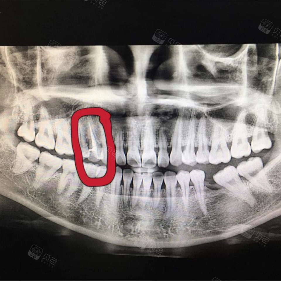 根管治疗x光片图片