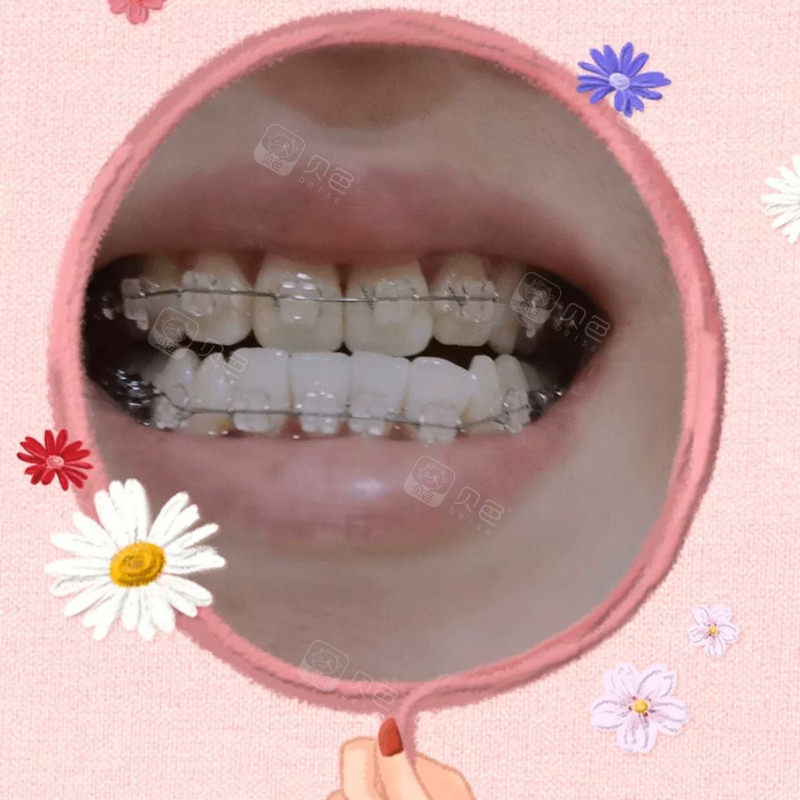 陶瓷半隐形牙齿矫正