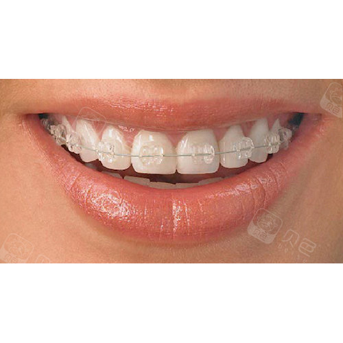 陶瓷自锁托槽矫正示意图