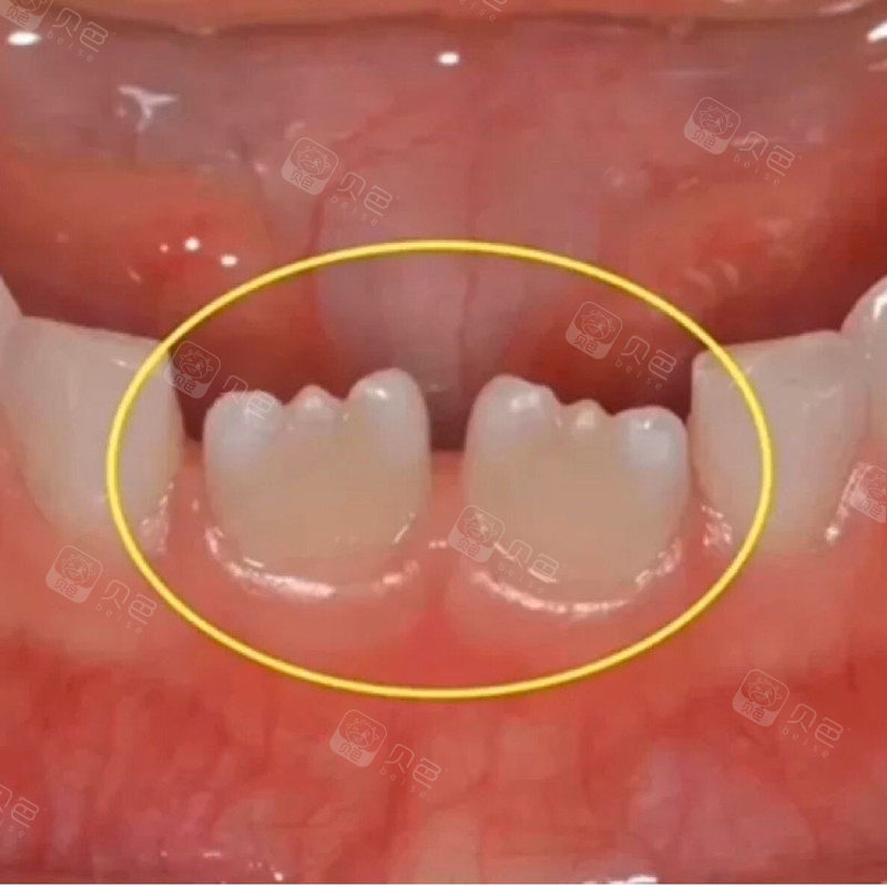 孩子新换的牙为什么不是平的,有宝宝是这样锯齿牙的吗?