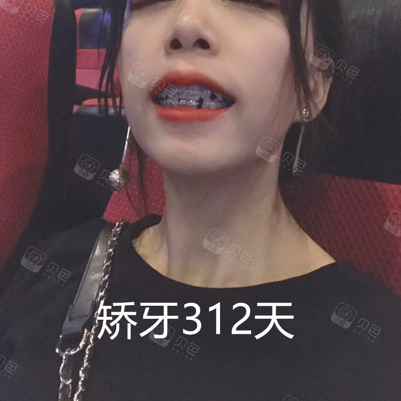 矫正后磨牙往里倾倒能弄好吗?