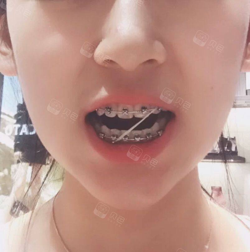钢牙妹分享做牙齿矫正挂皮筋的各种神奇玩法
