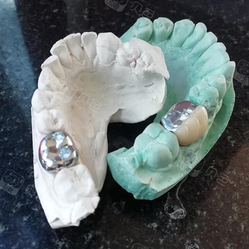 在苏州如果做一颗纯钛烤瓷牙价格会比全瓷贵多少?