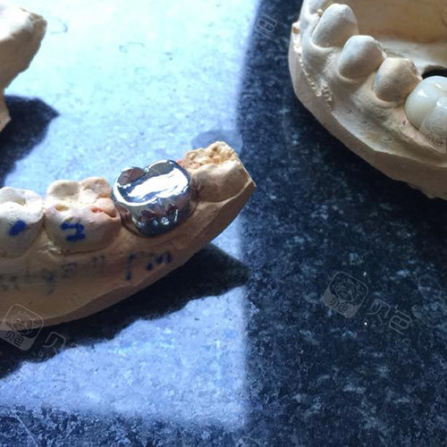 在苏州如果做一颗纯钛烤瓷牙价格会比全瓷贵多少?