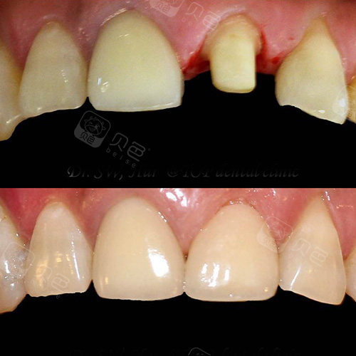 千万别被氧化锆牙齿价格给骗上当了正规氧化锆3000就差不多