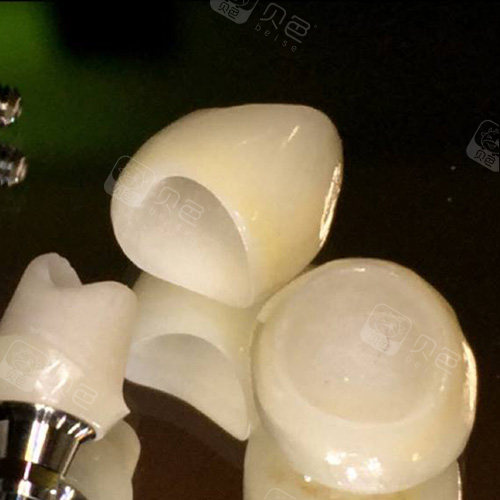 种植牙使用的全瓷牙冠
