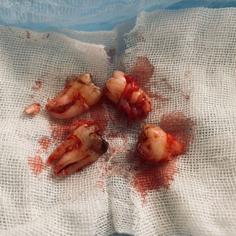 给宝宝们聊一下一次拔四颗智齿感受