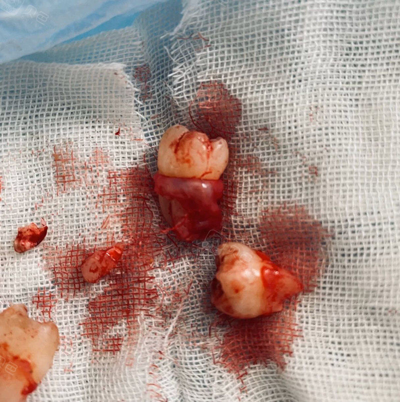 给宝宝们聊一下一次拔四颗智齿感受