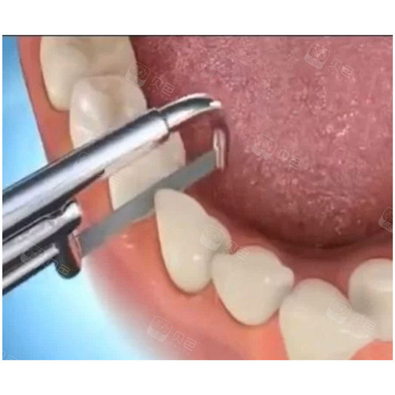 小小牙医为你科普:片切,扩弓,磨牙远移是什么?