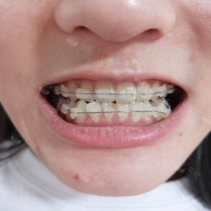 分享戴陶瓷牙套80多天的变化