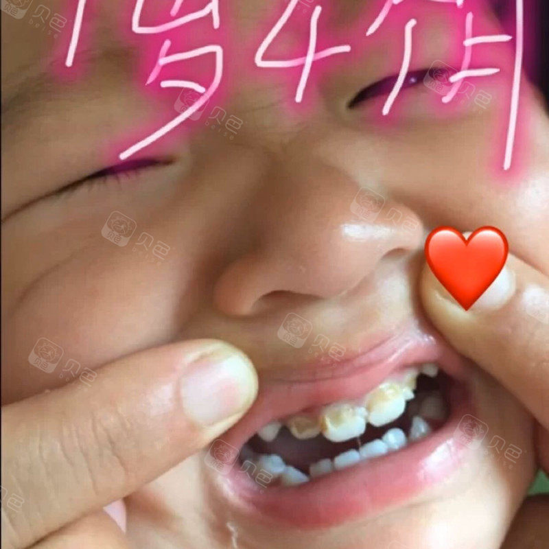 跟宝妈们分享一下奶瓶龋齿形成的原因