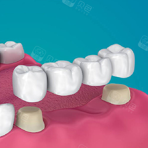 你镶一颗牙,通常医生算价格要算3颗!原因是修复烤瓷桥