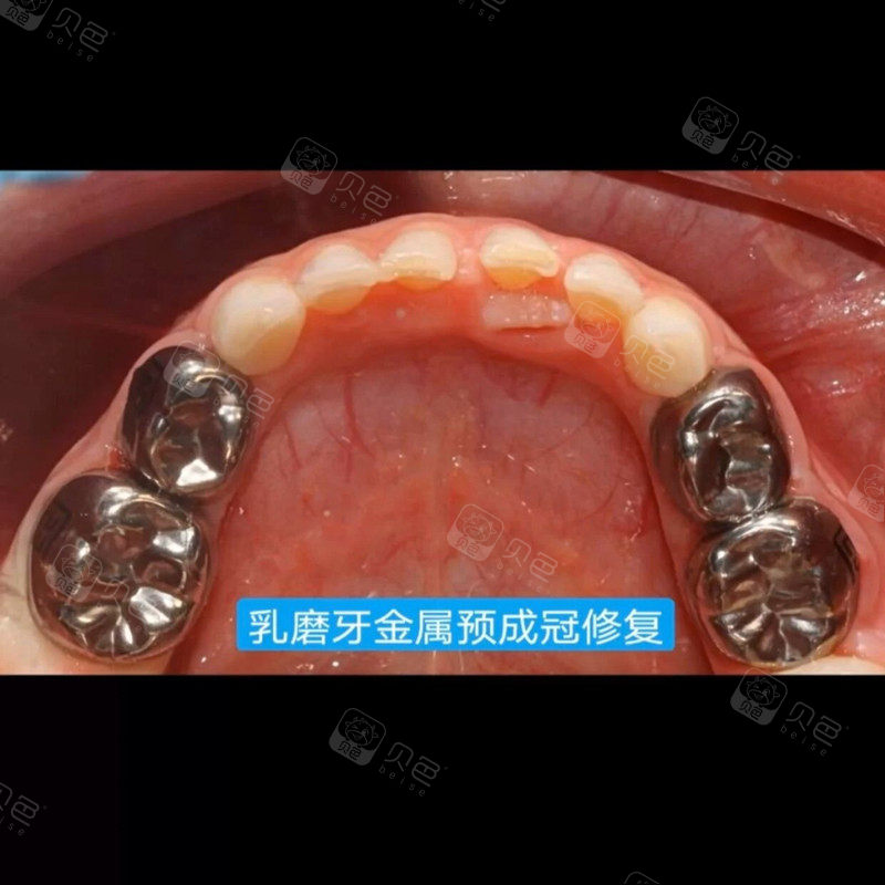分享一个6岁宝宝牙金属预成冠修复案例