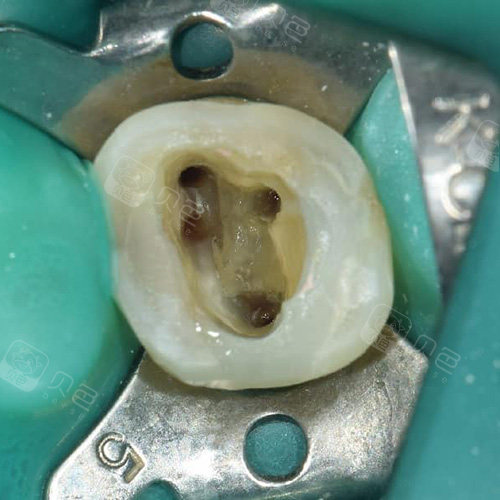 医生不会说的根管秘密深龋千万别补牙去做根管治疗