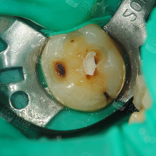 300元 口腔项目  补牙 恢复时间  7天 收藏 安抚治疗一般会用在龋齿