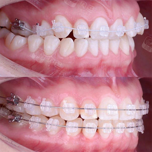 牙套使用一年后,陶瓷自锁和不自锁的白净度图片差异大不大?