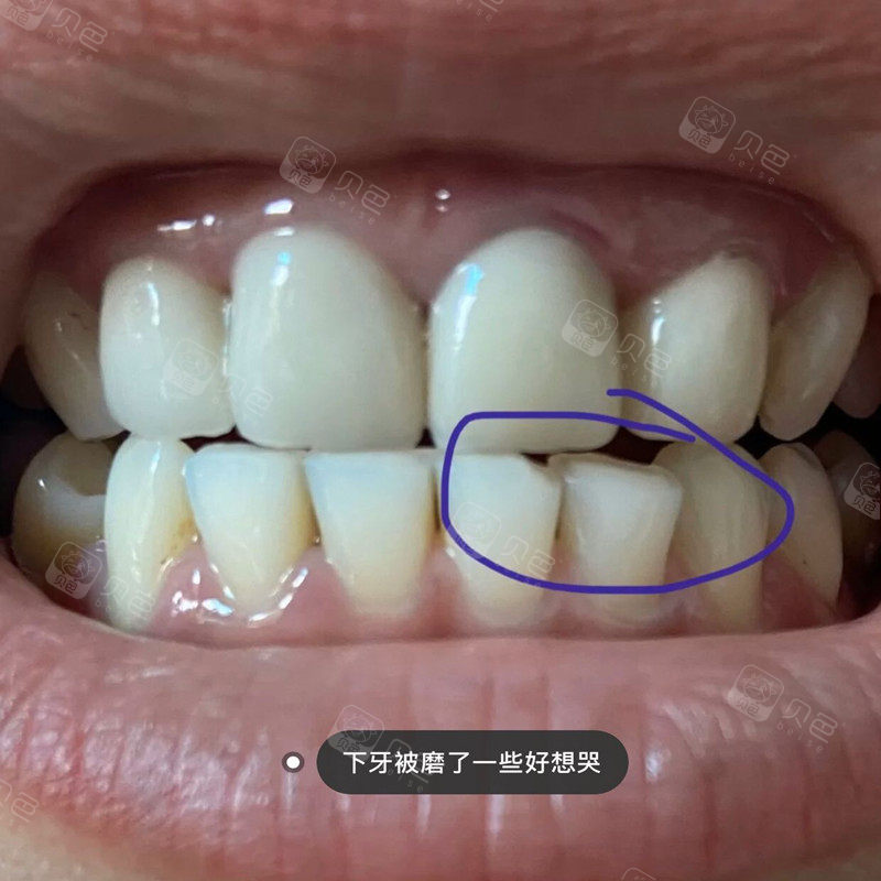 10年的烤瓷牙更换全瓷牙我的对齿是不是磨多了