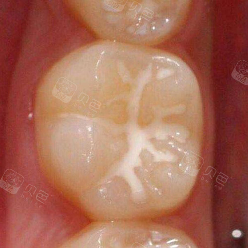 成年人还能做窝沟封闭?我在三门峡口腔的牙医这么说