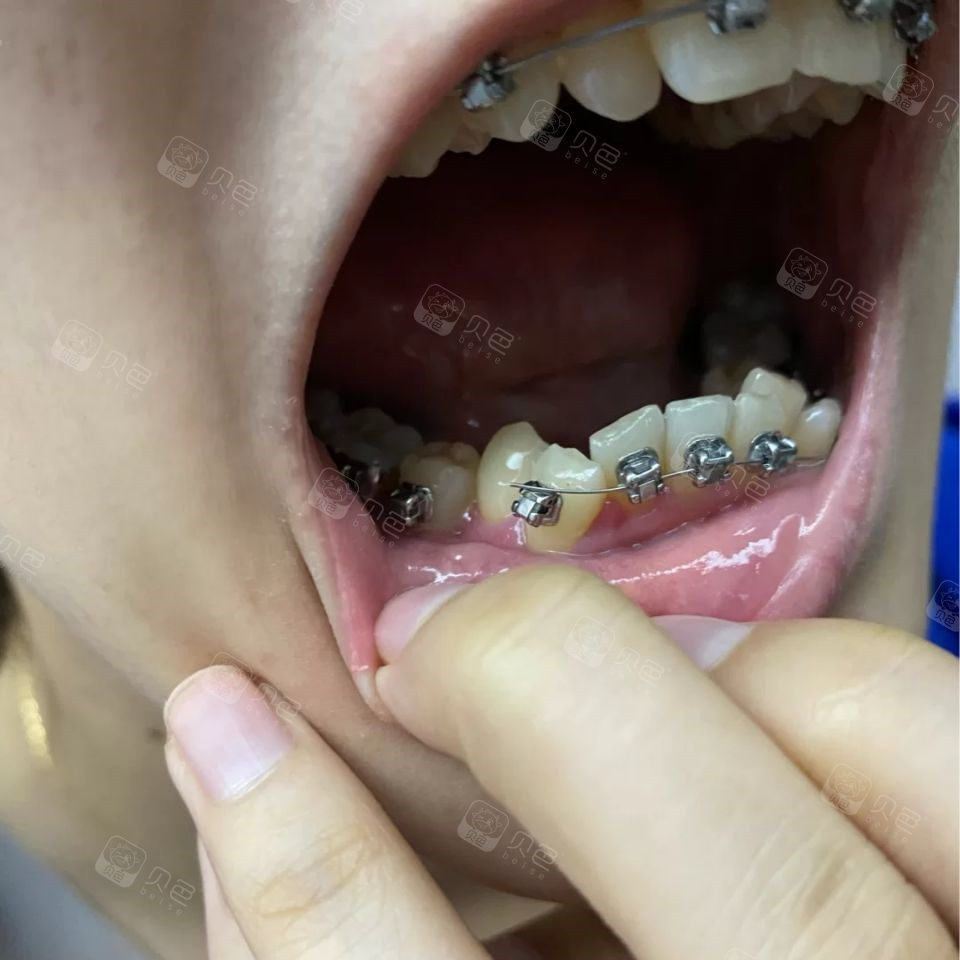 牙套钢丝断裂,还没有见过这种操作呢