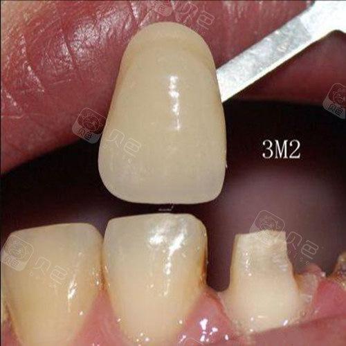全瓷牙齿颜色3m2怎么样
