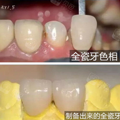 好多人都说3m2颜色的牙更自然,今天带大家看看真实照片!