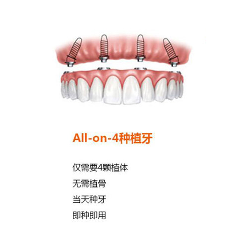 all-on-4种植牙优势