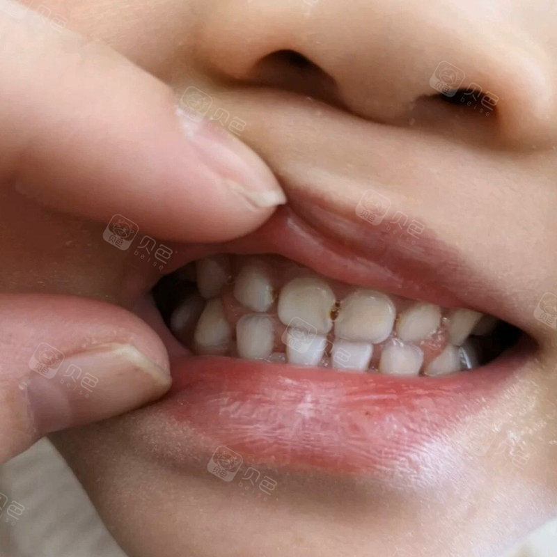 关于幼儿龋齿(蛀牙) 的治疗