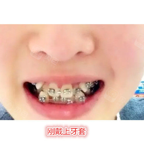 32岁虎牙正畸过程分享,花了17个月的时间终于变得美美哒!