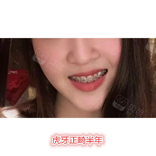 32岁虎牙正畸过程分享,花了17个月的时间终于变得美美哒!
