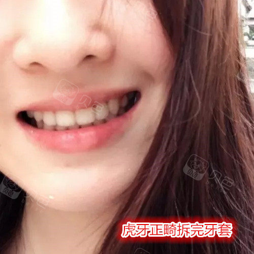 32岁虎牙正畸过程分享,花了17个月的时间终于变得美美哒!