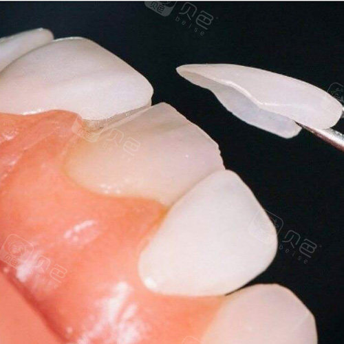 牙齿贴片需要打磨多少缝隙?做牙贴面可以不磨牙吗?