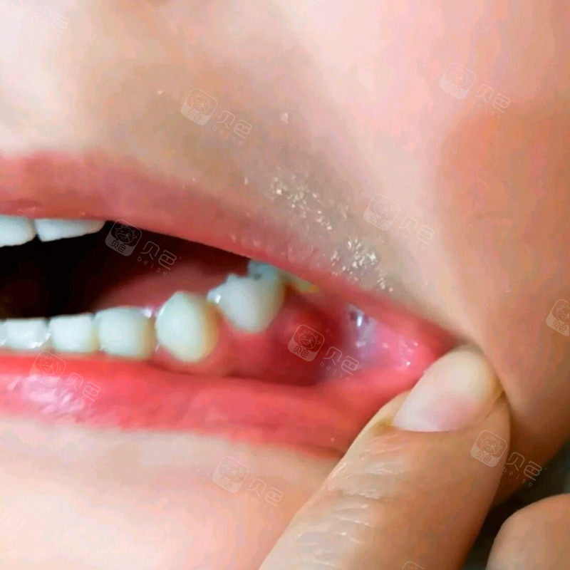 四岁宝宝牙龈发炎鼓包医生说是根尖囊肿还有龋齿