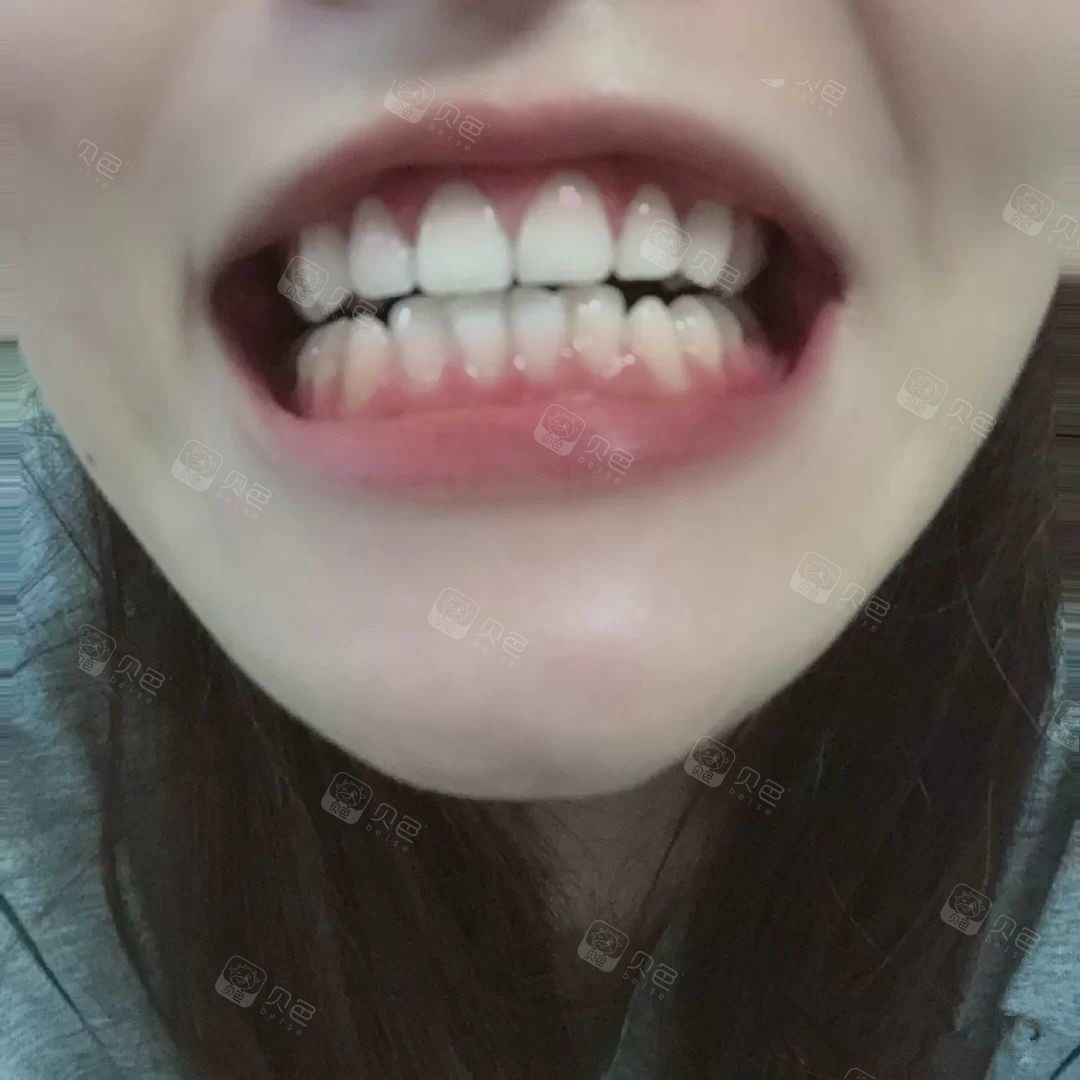 折腾,终于把2年的烤瓷牙换成全瓷牙