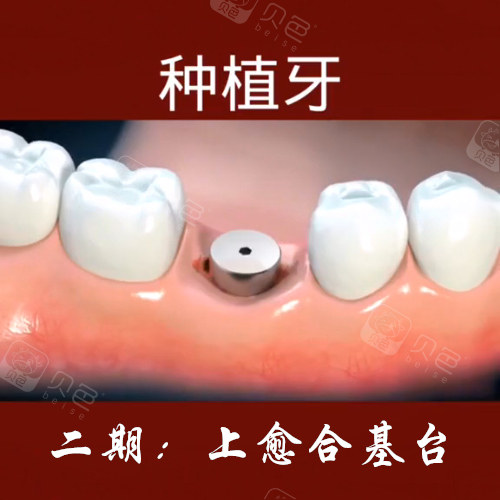 种植牙一期二期三期流程