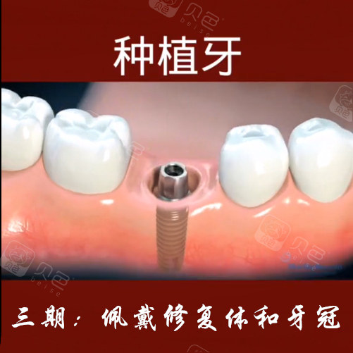 种植牙三期示意图