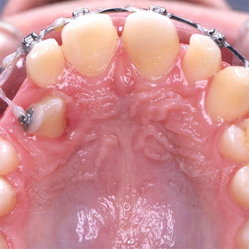 我来告诉你牙齿牵引怎么做,牵引过程是种怎样的体验!