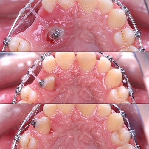 牙齿开窗牵引过程图片图片