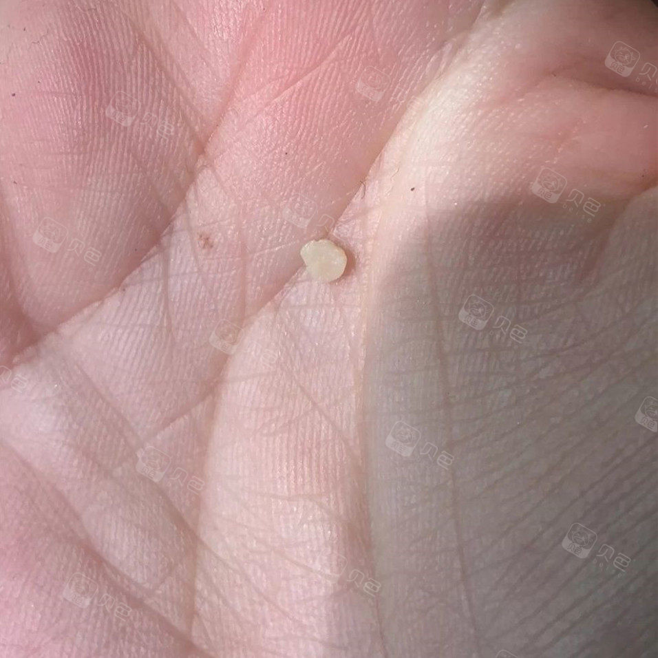 补牙材料又掉了