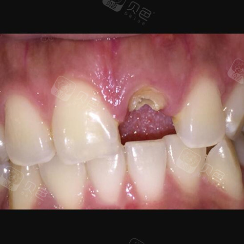 残冠残根留着不拔,当心炎症,移位,咬合紊乱,口腔癌等找上门