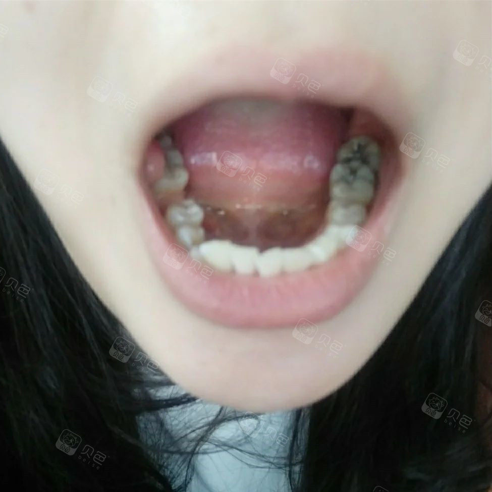 门牙牙缝树脂补牙利弊,大门牙树脂补牙缝图片,门牙补牙好还是贴面好_大山谷图库