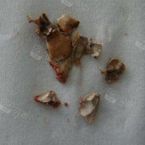 扣下来的牙结石实拍