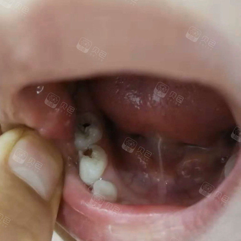 宝宝有了虫牙该不该补?