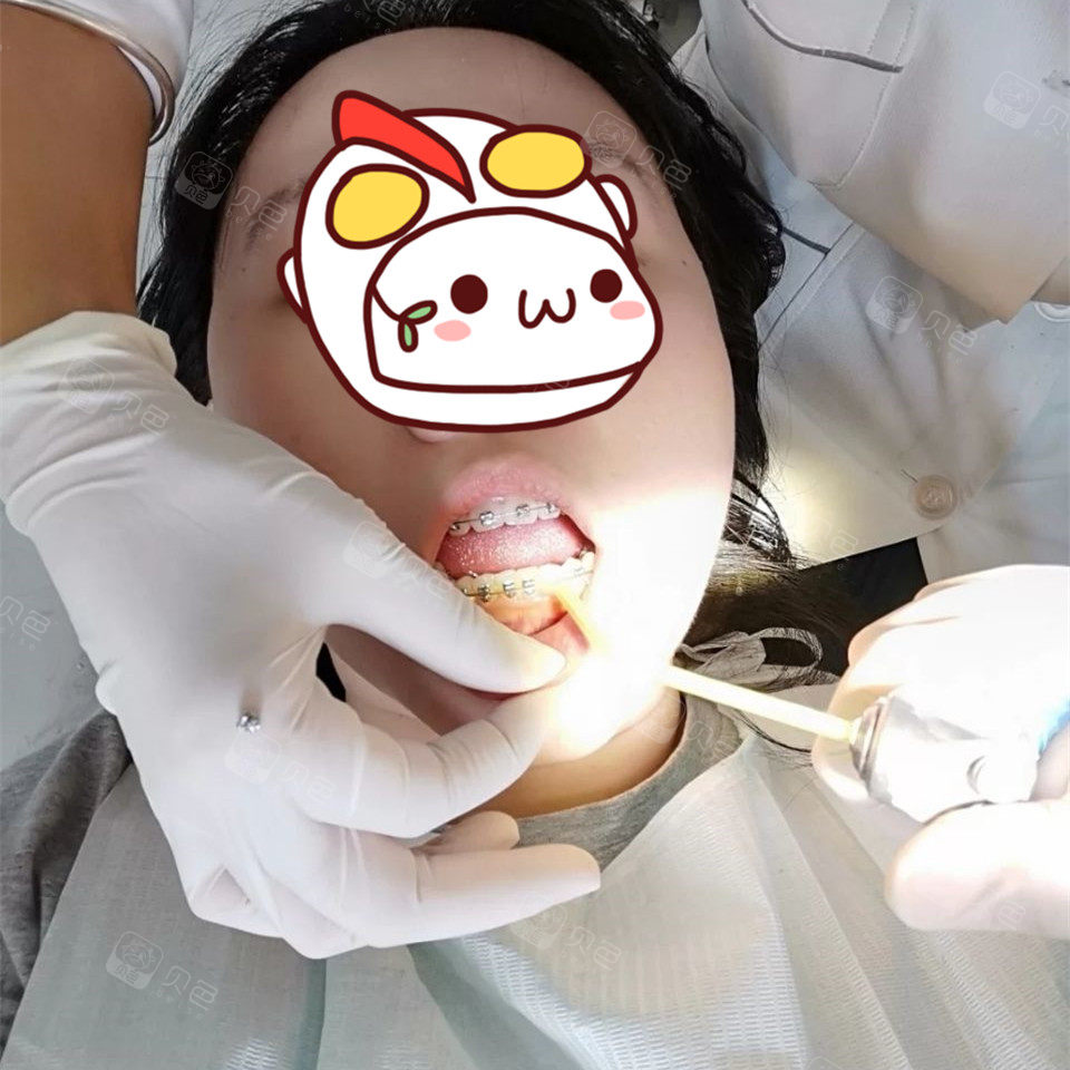 戴牙套